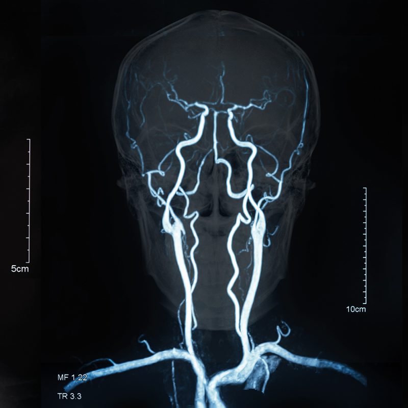 Perfusion measurement techniques